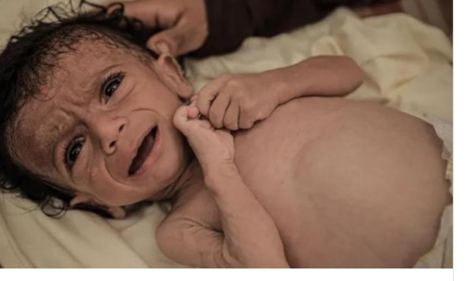 غزة: انتشار "الكرش" بين الأطفال رغم المجاعة يشير إلى مرض كواشيوركور غزة: انتشار "الكرش" بين الأطفال رغم المجاعة يشير إلى مرض كواشيوركور