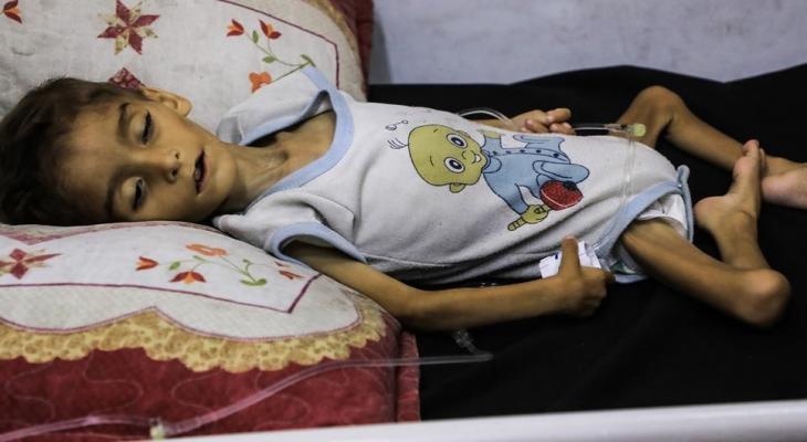 الصحة بغزة: تسجيل ست حالات وفاة نتيجة المجاعة خلال ال 24 ساعة الماضية