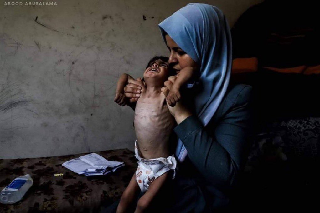   استشهاد طفل فلسطيني بسبب المجاعة في قطاع غزة والحصيلة ترتفع إلى 40 طفل