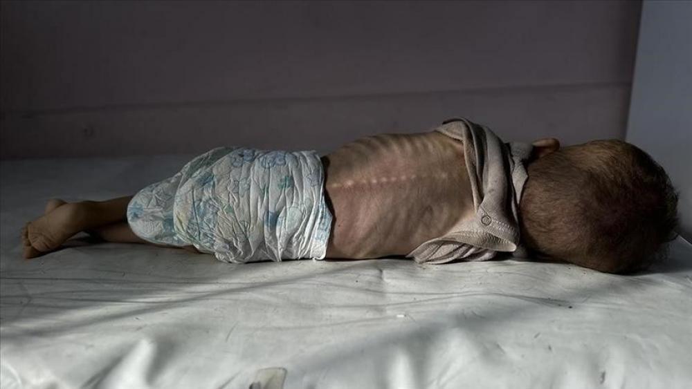 الصحة بغزة :تسجيل حالتي وفاة لطفلين نتيجة المجاعة خلال الـ24 ساعة الماضية