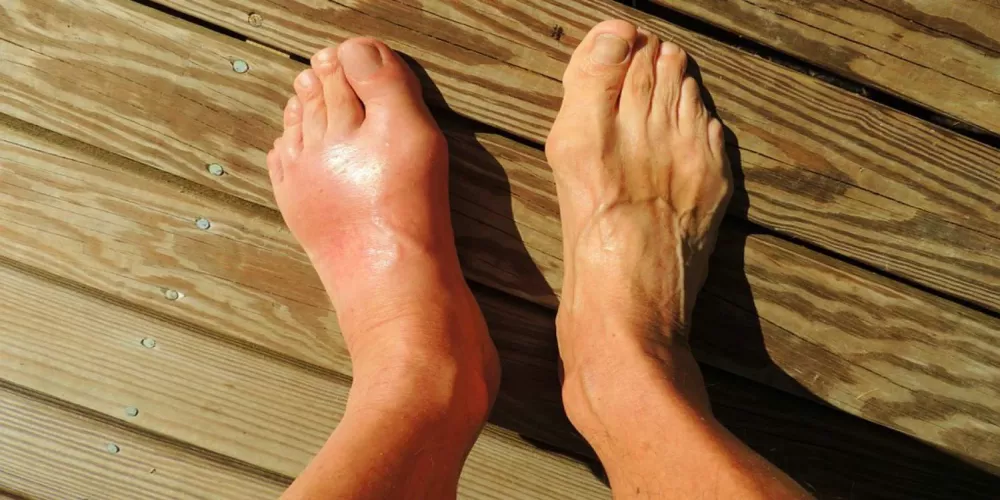  دراسة حديثة تظهر من أين يأتي النقرس – إنه ليس ما كنا نعتقد