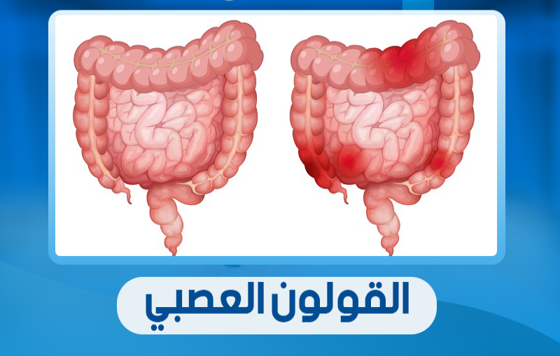 سرطان القولون.. العدو الصامت في الأمعاء