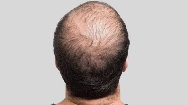 علاج جديد يعزز نمو الشعر ويقضي على الصلع علاج جديد يعزز نمو الشعر ويقضي على الصلع