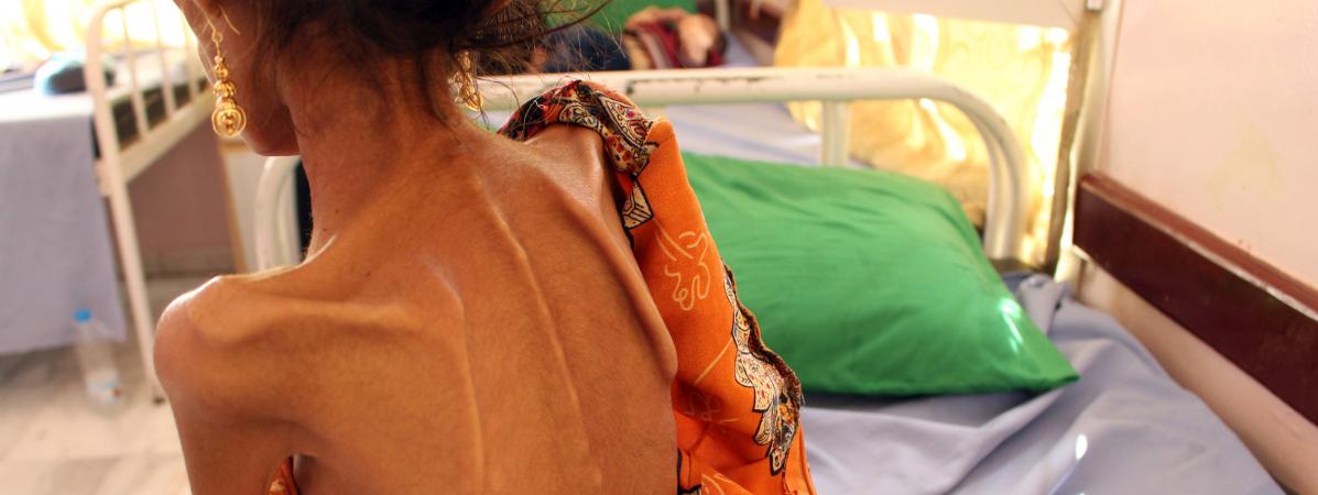 اليمن… استراتيجية الجوع اليمن… استراتيجية الجوع