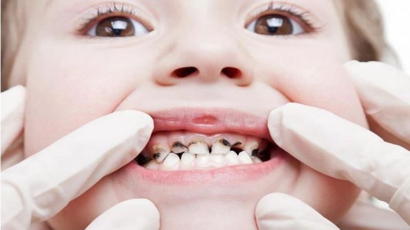 الأسنان “الطباشيرية” لدى الأطفال حيّرت الأطباء..ما هي؟ الأسنان “الطباشيرية” لدى الأطفال حيّرت الأطباء..ما هي؟