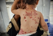 نقص مواد النظافة في غزة يتحول إلى قنبلة وبائية تهدد حياة النازحين