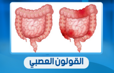 سرطان القولون.. العدو الصامت في الأمعاء