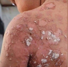 غزة: تسجيل أكثر من 9 آلاف إصابة بأمراض جلدية معدية خلال أسبوعين