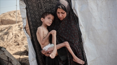 الأمم المتحدة: عدد حالات سوء التغذية الحاد بغزة ارتفع إلى 95 ألفا