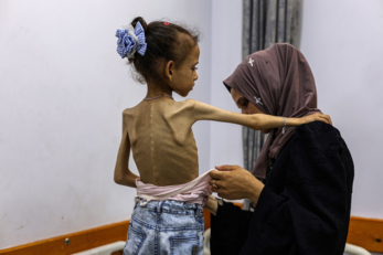 "صحة غزة": 6 حالات وفاة نتيجة المجاعة في قطاع غزة خلال الـ24 ساعة الماضية