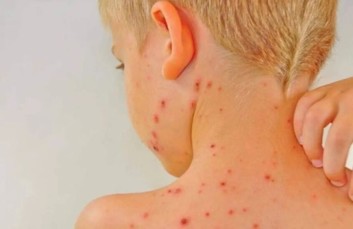 نائب ديمقراطي يدعو إلى إعلان حالة طوارئ صحية في اميركا بسبب الحصبة نائب ديمقراطي يدعو إلى إعلان حالة طوارئ صحية في اميركا بسبب الحصبة