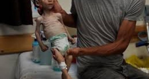 يونيسف: سوء التغذية بين أطفال غزة يصل إلى مستويات كارثية