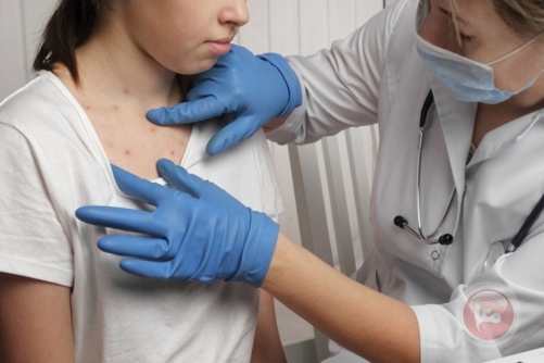 الحصبة تعود بقوة إلى أمريكا بأكثر من ألف إصابة مؤكدة و3 وفيات الحصبة تعود بقوة إلى أمريكا بأكثر من ألف إصابة مؤكدة و3 وفيات