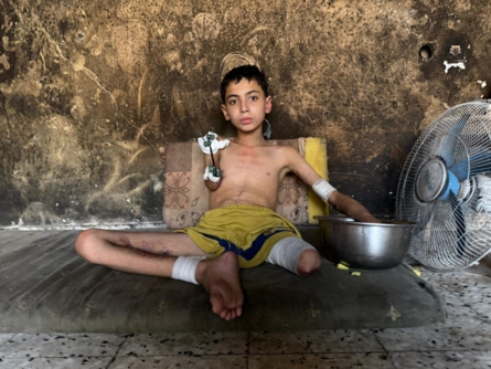 سمير زقوت.. طفلٌ غزّاوي قَطعت مُسيَّرة صهيونية أحلامه وأطرافه