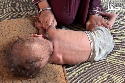 الصحة بغزة: خمس حالات وفاة جديدة بينهم طفلان نتيجة سوء التغذية في غزة
