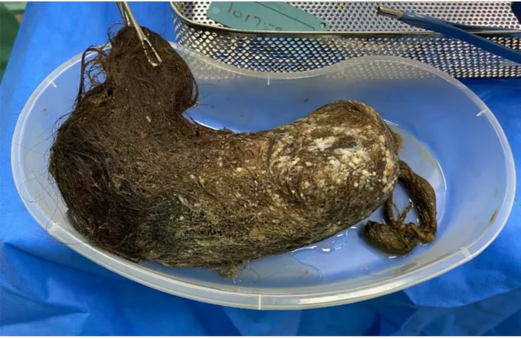 كرة شعر ضخمة تمزق جدار معدة شابة وتُدخلها الجراحة! كرة شعر ضخمة تمزق جدار معدة شابة وتُدخلها الجراحة!