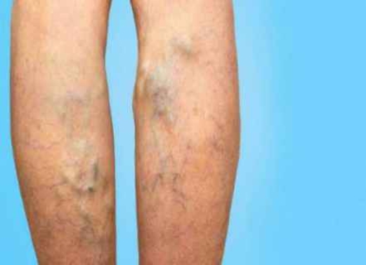 10 خطوات تساعدك في علاج دوالي الساقين 10 خطوات تساعدك في علاج دوالي الساقين