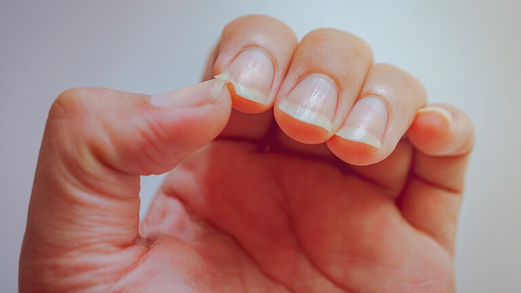 تغيّرات الأظافر تمثل “مؤشرا قويا” على الإصابة بالتهاب المفاصل