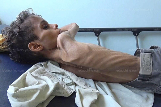84 ألف طفل ضحايا الجوع في اليمن وبن زايد في ضيافة ماكرون 84 ألف طفل ضحايا الجوع في اليمن وبن زايد في ضيافة ماكرون