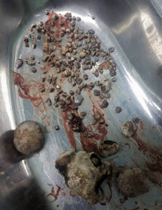 فريق طبي يمني ينجح في اجراء عمليتان نادرتان لاستخراج 177 حصوة من كلية مريض وحصوة بحجم كلية انسان فريق طبي يمني ينجح في اجراء عمليتان نادرتان لاستخراج 177 حصوة من كلية مريض وحصوة بحجم كلية انسان