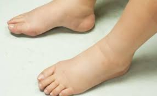 كيف تتخلص من السمنة الناجمة عن تراكم المياه بالجسم؟ كيف تتخلص من السمنة الناجمة عن تراكم المياه بالجسم؟