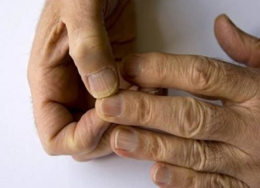 مؤشرات في الأظافر تدل على حالات صحية سلبية مؤشرات في الأظافر تدل على حالات صحية سلبية